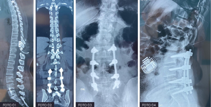 Cirurgias de descompressão